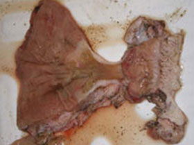  Figura 5. Tejido cicatrizal formando una constricción que se puede extender bastante en el intestino grueso